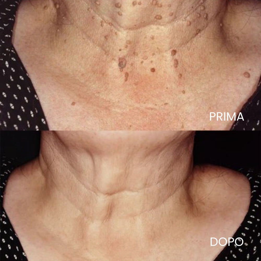 Dispositivo con Tecnologia laser al CO₂