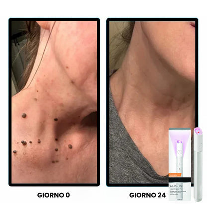 Dispositivo con Tecnologia laser al CO₂