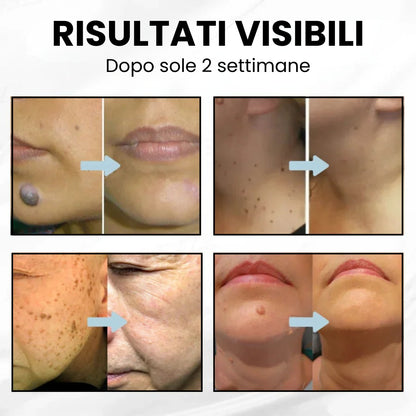 Dispositivo con Tecnologia laser al CO₂